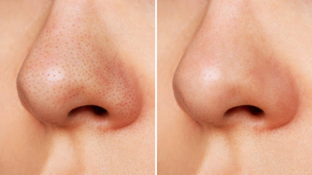 Ultrasonic Scrubber Blackhead Remover